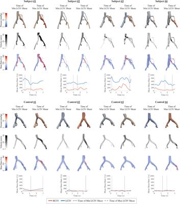 A comparative study of altered hemodynamics in iliac vein compression syndrome